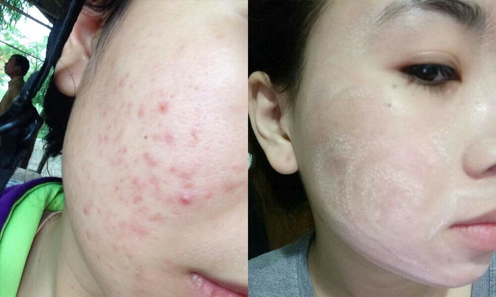 Trước và sau khi sử dụng thuốc tái tạo da của khách